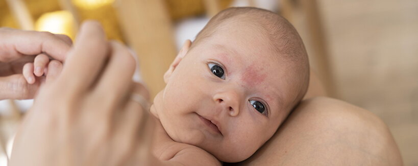 Neugeborenenakne: Warum entsteht sie und wie wird man sie los?